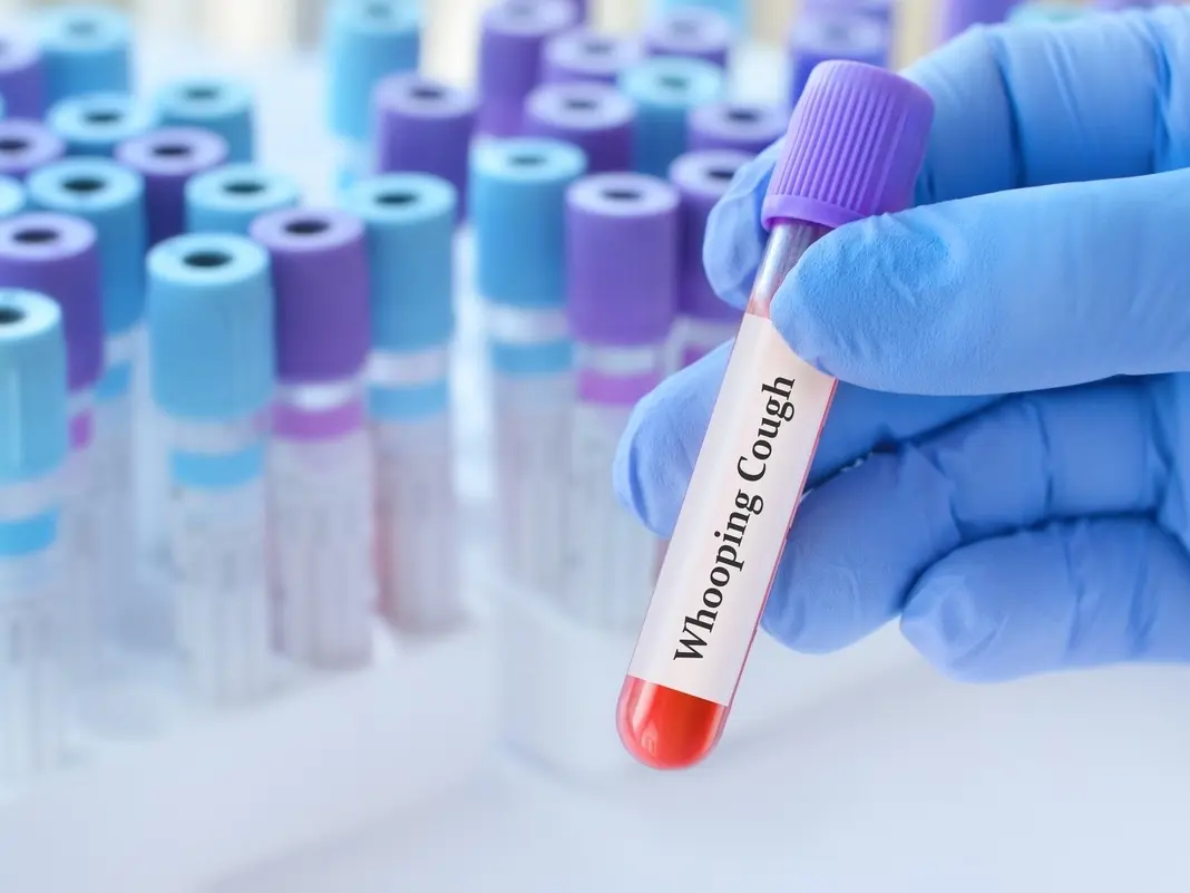 Whooping Cough Outbreak Hits LA County